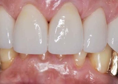Male teeth after cosmetic veneers