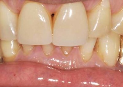 Male teeth before cosmetic veneers